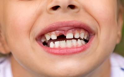 Kids mouth with missing tooth