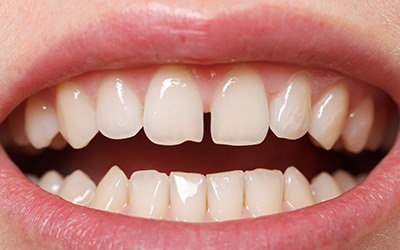Diastema between the upper incisors