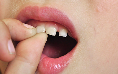 A young child pulling on a tooth