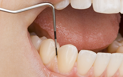 Up-close image of dental work being done on teeth